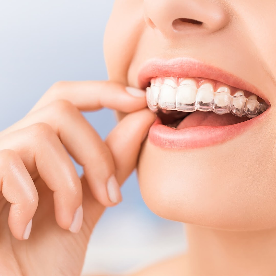 Close-up of a person holding a clear dental aligner over their teeth