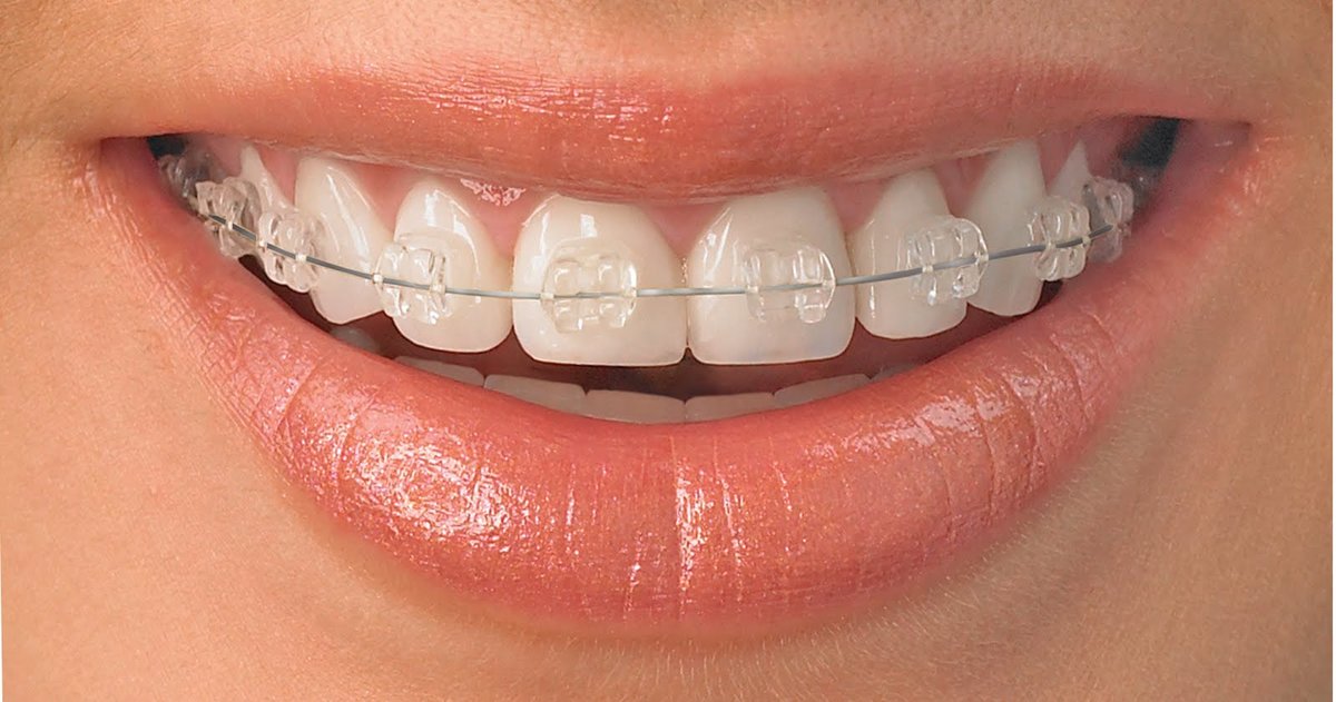 Close-up view of a smile with clear orthodontic brackets